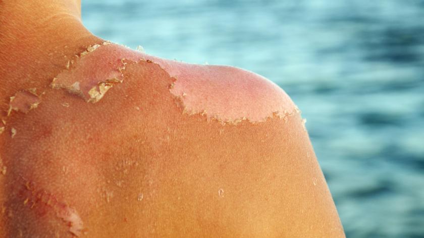 Peau Qui Pele Soin Et Recette De Cosmetique Maison Pour Une Peau Douce
