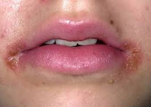 Cheilite Angulaire Comment S En Debarrasser