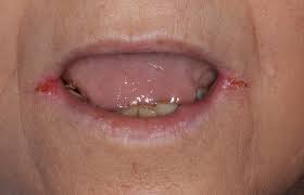 Cheilite Angulaire Comment S En Debarrasser