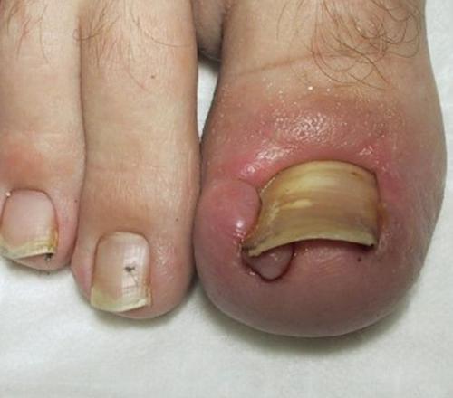 Guerir Prevenir Les Ongles Incarnes Le Tout Naturellement Guerir Prevenir Les Ongles Incarnes Le Tout Naturellement