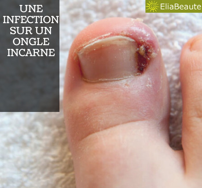 ongle incarné : Comment soigner un ongle incarné ?