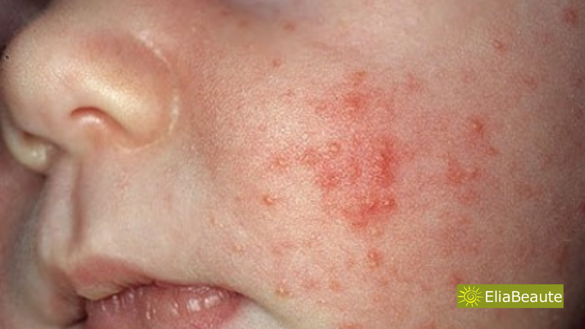 Acne Du Nourrisson Que Faire Acne Du Nourrisson Que Faire
