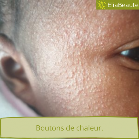 Acné du nourrisson que faire? — free download