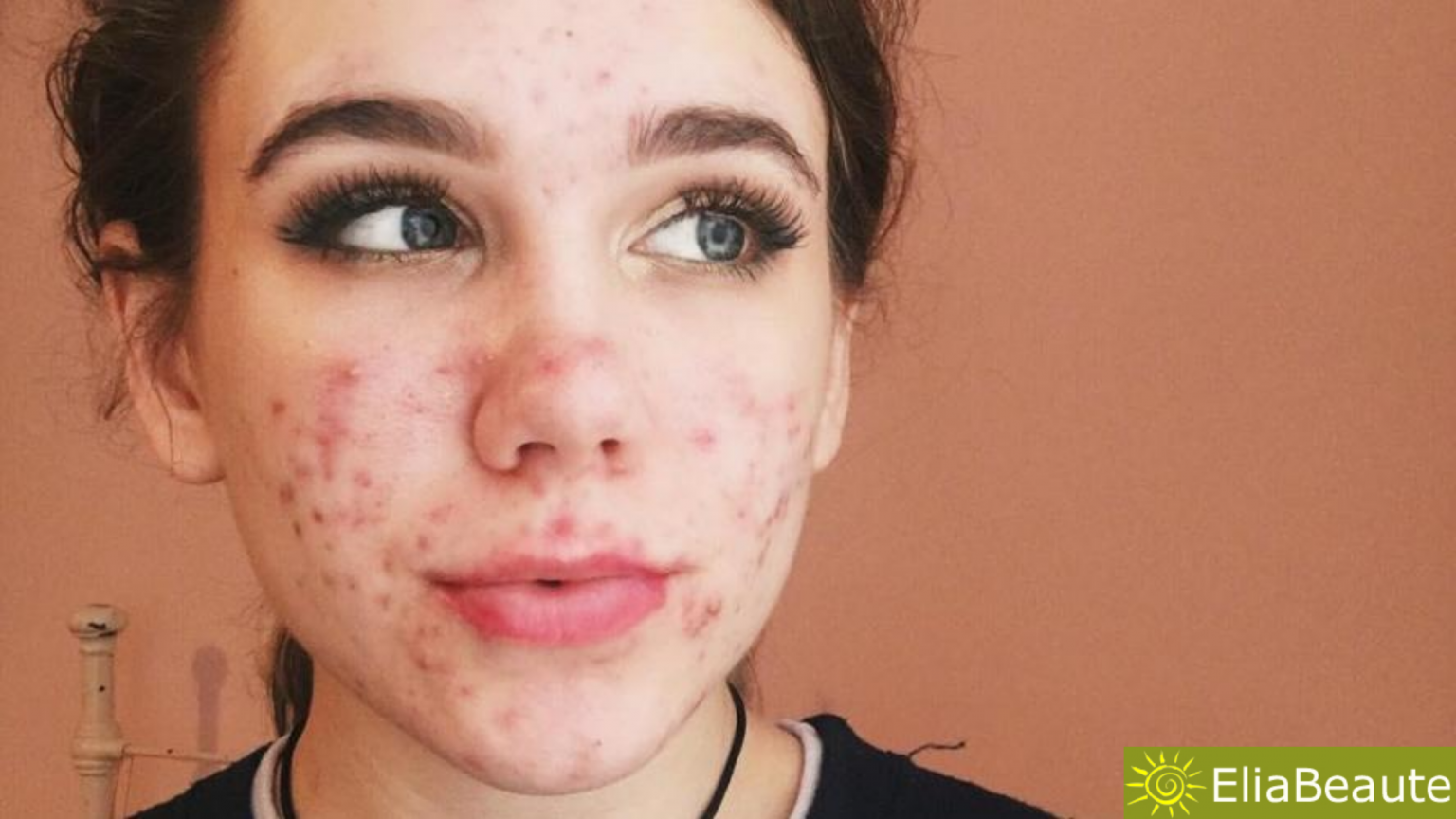 Acnés causes, traitements naturels efficaces